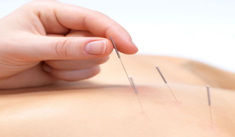 acupuncture Club Physio Plus acupuncture Club Physio Plus